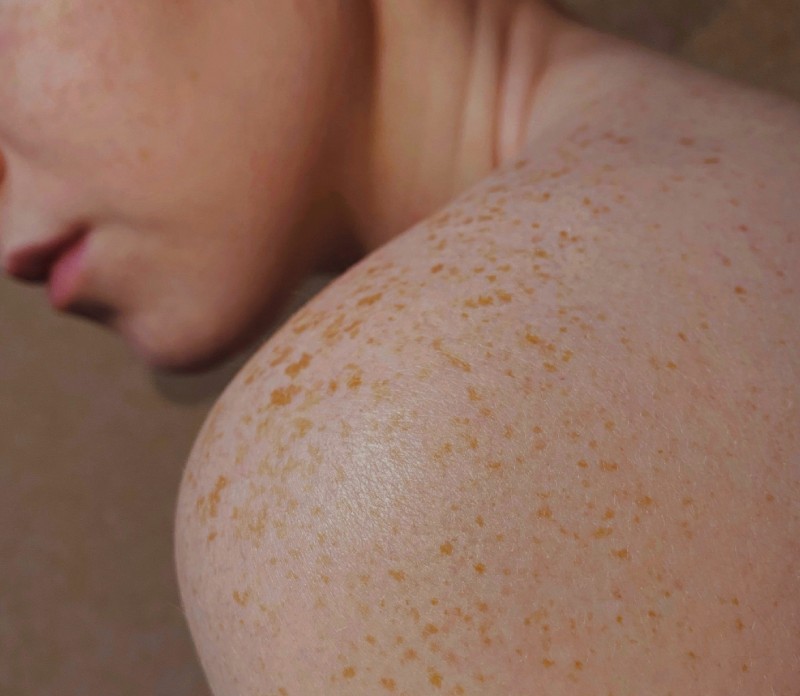 Eczema: A Singapore Dermatologist’s Guide